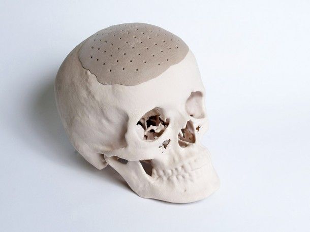 Gezichtsreconstructie met 3D printen