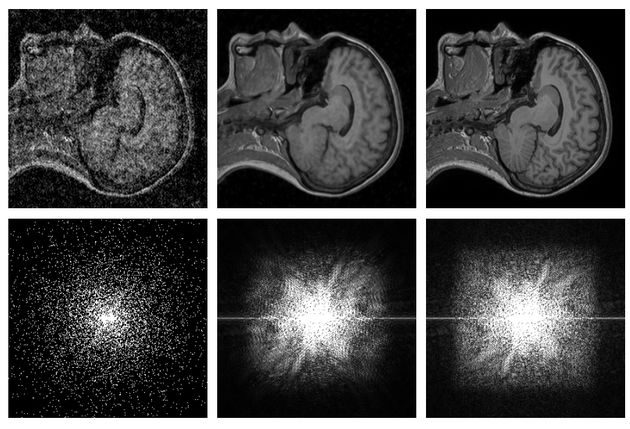 AI scan MRI